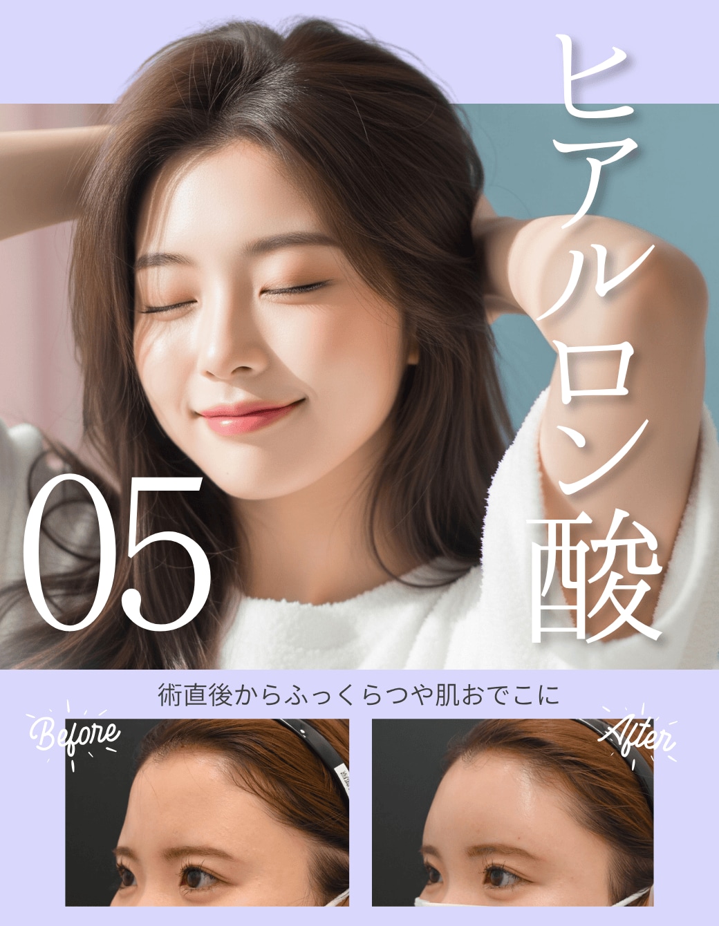 【ヒアルロン酸】気になる部分だけアプデ♪